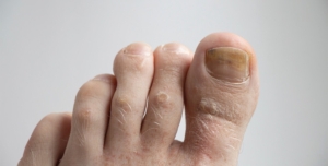 Νύχι ποδιού με εμφανή μύκητα (ονυχομυκητίαση) που έχει προκαλέσει κιτρίνισμα και πάχυνση της πλάκας.