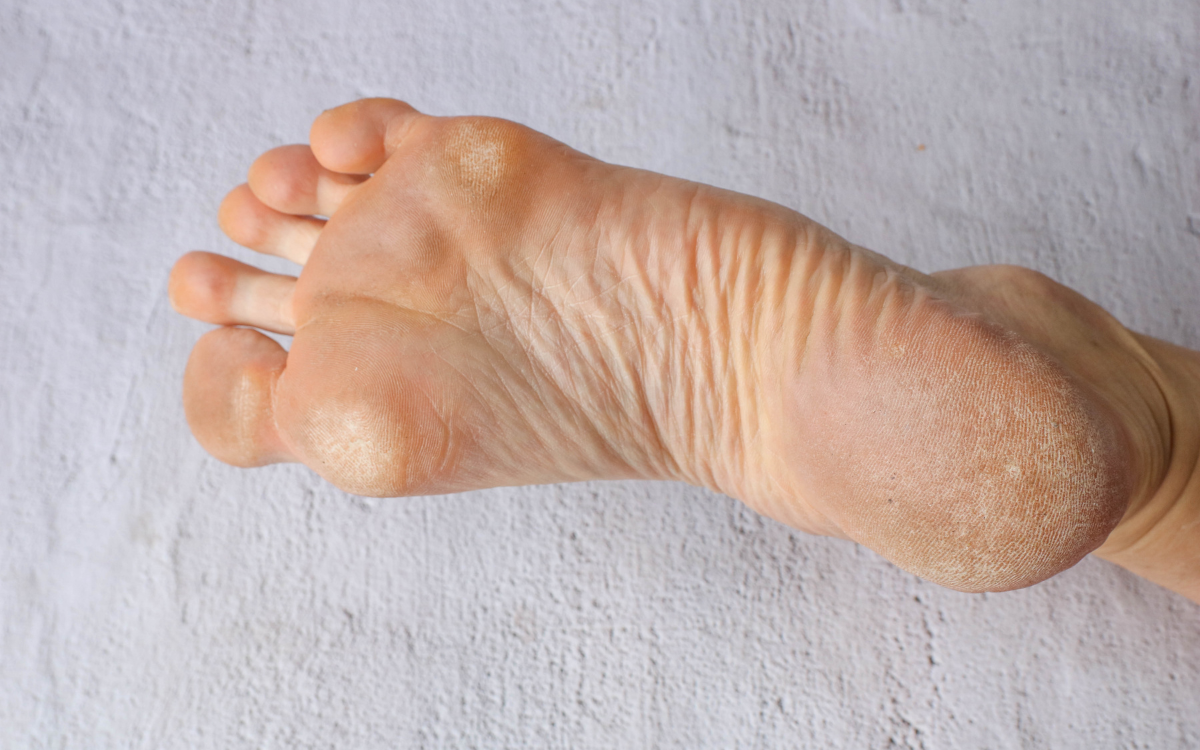 Υπερκεράτωση φτέρνας: Τι είναι και τρόποι αντιμετώπισης patousa-me-yperkeratosi