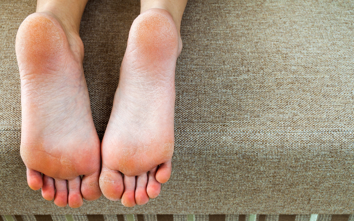 duo-patouses-me-yperkeratosi-fternas